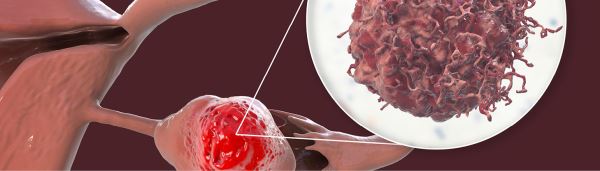 Скрытая угроза: врачи рассказали, почему рак яичников часто выявляют на поздних стадиях