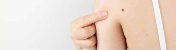 Клеточная пластичность при меланоме обусловлена нарушением метаболизма железа